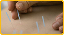 Acupuncture